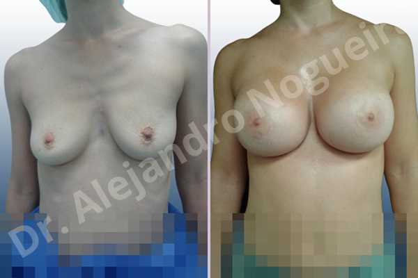 Empty breasts,Mildly saggy droopy breasts,Narrow breasts,Pendulous breasts,Skinny breasts,Sunken chest,Small breasts,Anatomical shape,Extra large size,Lower hemi periareolar incision,Subfascial pocket plane - photo 1