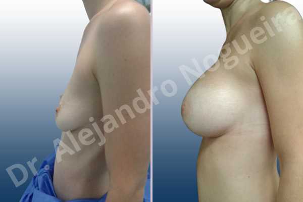 Empty breasts,Mildly saggy droopy breasts,Narrow breasts,Pendulous breasts,Skinny breasts,Sunken chest,Small breasts,Anatomical shape,Extra large size,Lower hemi periareolar incision,Subfascial pocket plane - photo 2