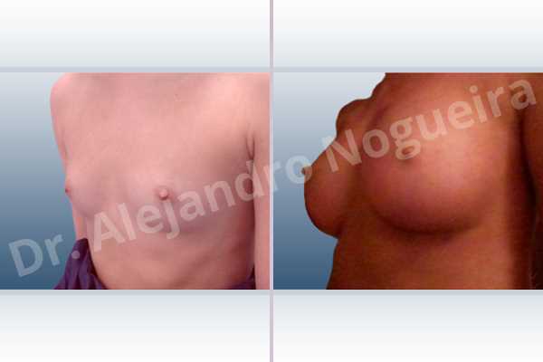 Asymmetric breasts,Empty breasts,Lateral breasts,Narrow breasts,Skinny breasts,Small breasts,Too far apart wide cleavage breasts,Anatomical shape,Inframammary incision,Subfascial pocket plane - photo 3