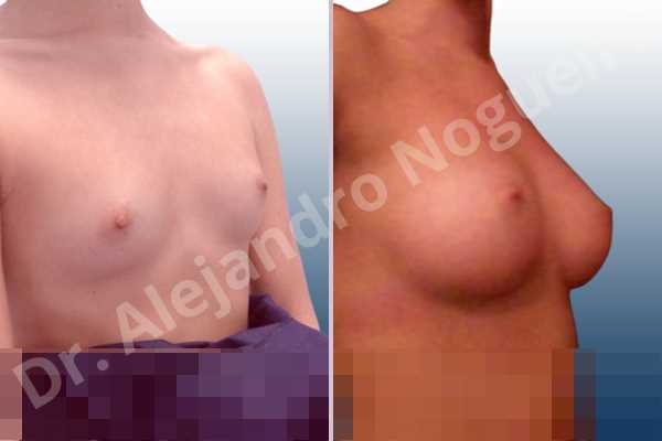 Asymmetric breasts,Empty breasts,Lateral breasts,Narrow breasts,Skinny breasts,Small breasts,Too far apart wide cleavage breasts,Anatomical shape,Inframammary incision,Subfascial pocket plane - photo 5