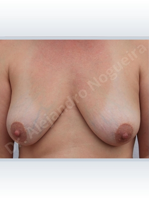 Asymmetric breasts,Empty breasts,Lateral breasts,Mildly saggy droopy breasts,Moderately saggy droopy breasts,Pendulous breasts,Slightly large breasts,Wide breasts,Tuberous breasts,Anatomical shape,Lollipop incision,Subfascial pocket plane,Superior pedicle