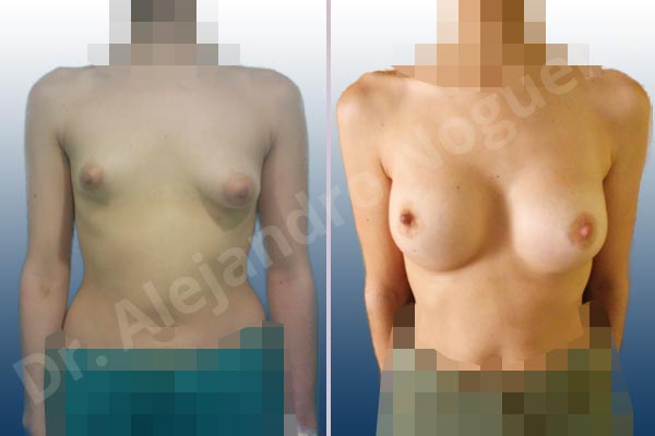 Asymmetric breasts,Empty breasts,Large areolas,Narrow breasts,Slightly saggy droopy breasts,Small breasts,Too far apart wide cleavage breasts,Tuberous breasts,Anatomical shape,Areola reduction,Circumareolar incision,Subfascial pocket plane,Tuberous mammoplasty - photo 1