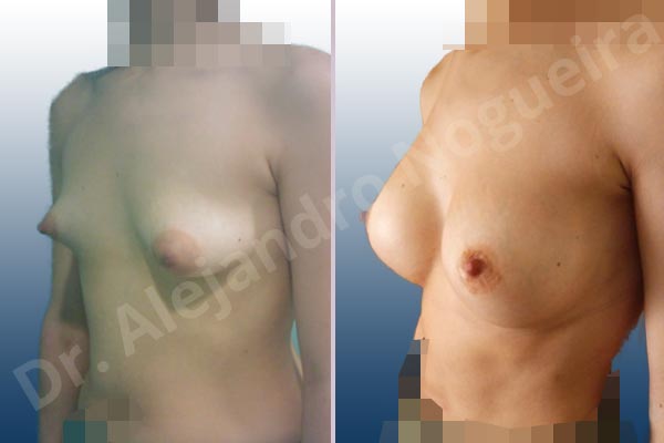 Asymmetric breasts,Empty breasts,Large areolas,Narrow breasts,Slightly saggy droopy breasts,Small breasts,Too far apart wide cleavage breasts,Tuberous breasts,Anatomical shape,Areola reduction,Circumareolar incision,Subfascial pocket plane,Tuberous mammoplasty - photo 3