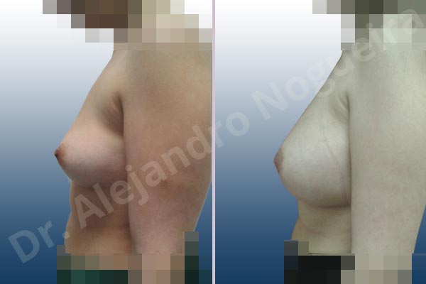 Empty breasts,Lateral breasts,Slightly saggy droopy breasts,Too far apart wide cleavage breasts,Wide breasts,Anatomical shape,Circumareolar incision,Subfascial pocket plane - photo 2