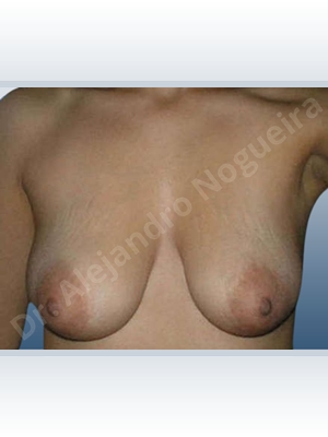 Asymmetric breasts,Cross eyed breasts,Empty breasts,Large areolas,Mildly large breasts,Moderately large breasts,Moderately saggy droopy breasts,Narrow breasts,Pendulous breasts,Severely saggy droopy breasts,Slightly large breasts,Sunken chest,Tuberous breasts,Anatomical shape,Anchor incision,Areola reduction,Double vertical pedicle,Extra large size,Subfascial pocket plane