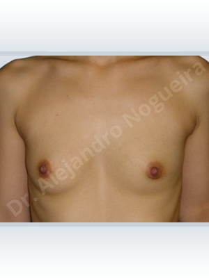 Asymmetric breasts,Lateral breasts,Skinny breasts,Small breasts,Extra large size,Lower hemi periareolar incision,Round shape,Subfascial pocket plane