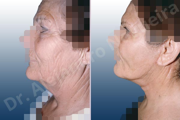 Baggy lower eyelids,Baggy upper eyelids,Deep nasolabial folds,Double chin flab,Droopy cheeks,Droopy face,Saggy jowls,Saggy neck,Saggy upper eyelids,Deep plane SMAS platysma face and neck lift,Lower eyelid fat bags resection,Transconjunctival approach incision,Upper eyelid fat bags resection,Upper eyelid skin and muscle resection - photo 1