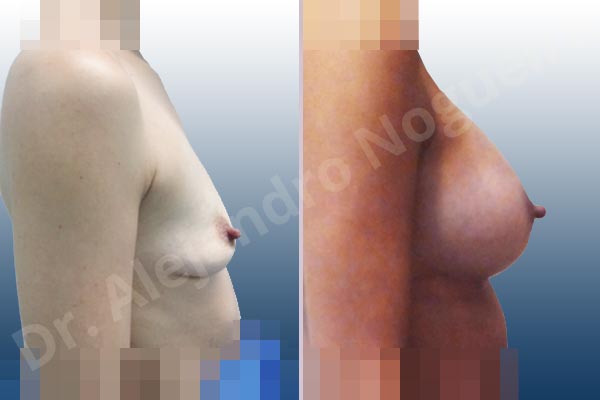 Empty breasts,Slightly saggy droopy breasts,Small breasts,Anatomical shape,Lower hemi periareolar incision,Subfascial pocket plane - photo 2