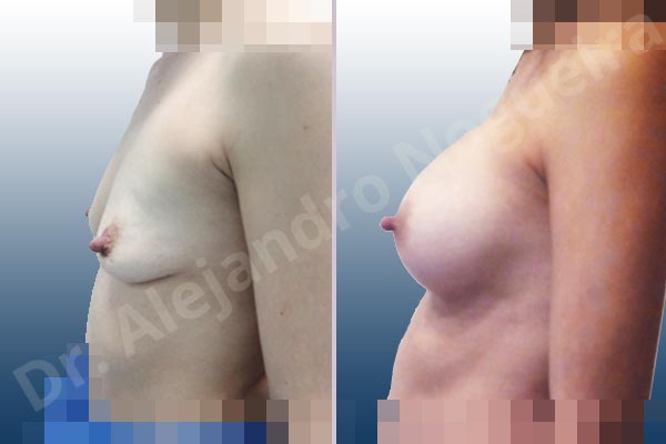 Empty breasts,Slightly saggy droopy breasts,Small breasts,Anatomical shape,Lower hemi periareolar incision,Subfascial pocket plane - photo 4