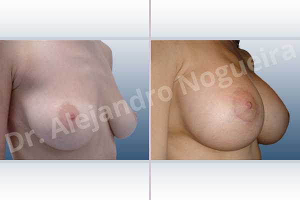 Empty breasts,Lateral breasts,Moderately large breasts,Moderately saggy droopy breasts,Pendulous breasts,Severely saggy droopy breasts,Skinny breasts,Slightly large breasts,Too far apart wide cleavage breasts,Anatomical shape,Extra large size,Lower hemi periareolar incision,Subfascial pocket plane - photo 5