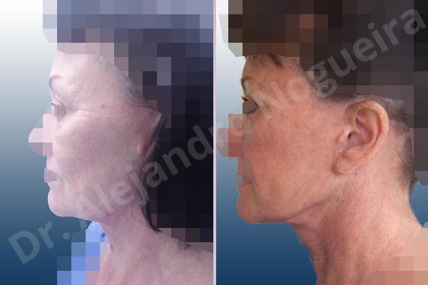 Cobra neck deformity,Deep nasolabial folds,Droopy cheeks,Droopy face,Lateral sweep deformity,Persistent jowls,Plump tragus,Saggy jowls,Tragus pull,Vertical sweep deformity,Deep plane SMAS platysma face and neck lift,Excisional scar revision - photo 3