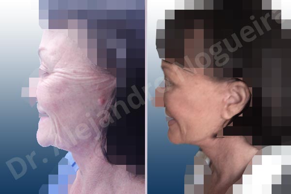 Cobra neck deformity,Deep nasolabial folds,Droopy cheeks,Droopy face,Lateral sweep deformity,Persistent jowls,Plump tragus,Saggy jowls,Tragus pull,Vertical sweep deformity,Deep plane SMAS platysma face and neck lift,Excisional scar revision - photo 4