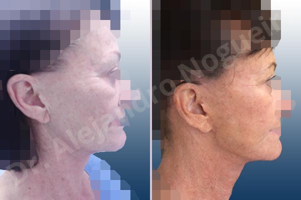 Cobra neck deformity,Deep nasolabial folds,Droopy cheeks,Droopy face,Lateral sweep deformity,Persistent jowls,Plump tragus,Saggy jowls,Tragus pull,Vertical sweep deformity,Deep plane SMAS platysma face and neck lift,Excisional scar revision - photo 7