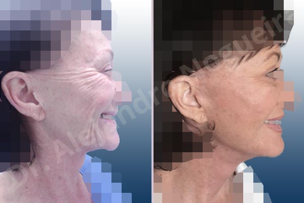 Cobra neck deformity,Deep nasolabial folds,Droopy cheeks,Droopy face,Lateral sweep deformity,Persistent jowls,Plump tragus,Saggy jowls,Tragus pull,Vertical sweep deformity,Deep plane SMAS platysma face and neck lift,Excisional scar revision - photo 8