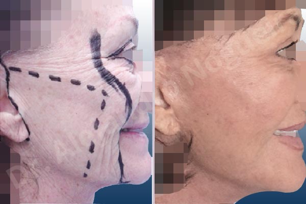 Cobra neck deformity,Deep nasolabial folds,Droopy cheeks,Droopy face,Lateral sweep deformity,Persistent jowls,Plump tragus,Saggy jowls,Tragus pull,Vertical sweep deformity,Deep plane SMAS platysma face and neck lift,Excisional scar revision - photo 9