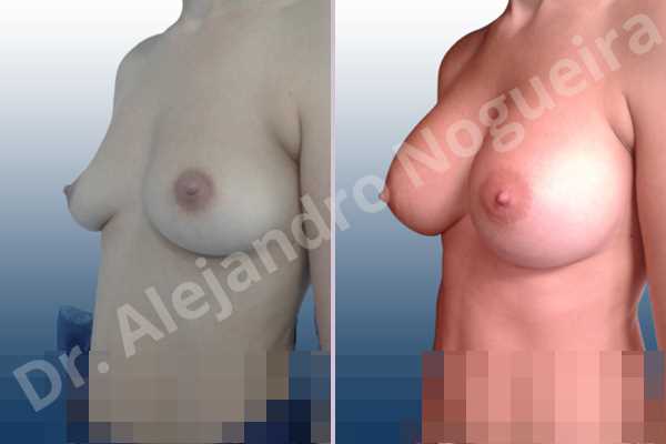 Asymmetric breasts,Cross eyed breasts,Empty breasts,Large areolas,Lateral breasts,Moderately saggy droopy breasts,Pendulous breasts,Pigeon chest,Small breasts,Too far apart wide cleavage breasts,Anatomical shape,Lower hemi periareolar incision,Subfascial pocket plane - photo 3