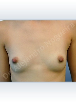 Lateral breasts,Narrow breasts,Skinny breasts,Small breasts,Too far apart wide cleavage breasts,Lower hemi periareolar incision,Round shape,Subfascial pocket plane