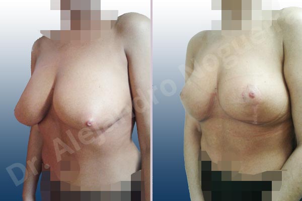 Cross eyed breasts,Lateral breasts,Moderately saggy droopy breasts,Too far apart wide cleavage breasts,Tuberous breasts,Wide breasts,Custom made size and shape,Lollipop incision,Superior pedicle - photo 3