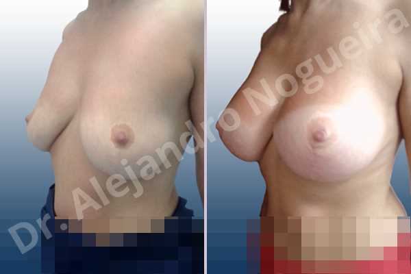 Asymmetric breasts,Breast tissue bottoming out,Cross eyed breasts,Empty breasts,Failed breast reduction,Moderately saggy droopy breasts,Pendulous breasts,Pigeon chest,Slightly saggy droopy breasts,Small breasts,Wide scars,Anatomical shape,Anchor incision,Custom incision,Extra large size,Subfascial pocket plane - photo 4