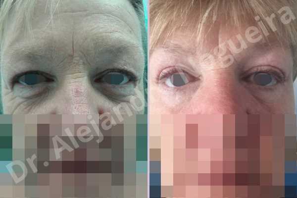 Baggy lower eyelids,Baggy upper eyelids,Saggy lower eyelids,Saggy upper eyelids,Upper eyelids ptosis,Lower eyelid fat bags resection,Lower eyelid skin and muscle resection,Subciliary approach incision,Upper eyelid fat bags resection,Upper eyelid skin and muscle resection - photo 1