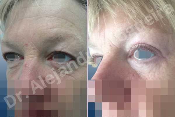 Baggy lower eyelids,Baggy upper eyelids,Saggy lower eyelids,Saggy upper eyelids,Upper eyelids ptosis,Lower eyelid fat bags resection,Lower eyelid skin and muscle resection,Subciliary approach incision,Upper eyelid fat bags resection,Upper eyelid skin and muscle resection - photo 3