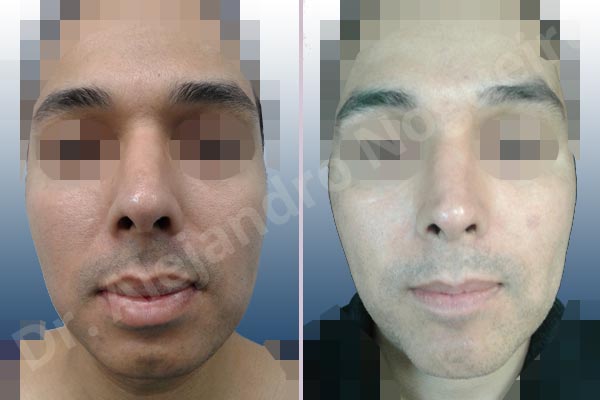 Small chin,Weak chin,Large lips,Lower lip vermilion wedge resection,Elbow bone graft harvesting,Horizontal osseous chin grafting,Oblique chin osteotomy,Osseous chin advancement,Two dimensional genioplasty