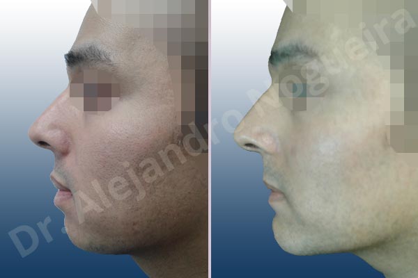 Small chin,Weak chin,Large lips,Lower lip vermilion wedge resection,Elbow bone graft harvesting,Horizontal osseous chin grafting,Oblique chin osteotomy,Osseous chin advancement,Two dimensional genioplasty - photo 2
