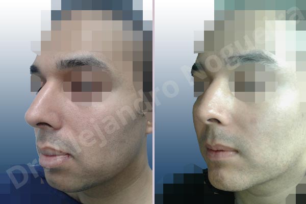 Small chin,Weak chin,Large lips,Lower lip vermilion wedge resection,Elbow bone graft harvesting,Horizontal osseous chin grafting,Oblique chin osteotomy,Osseous chin advancement,Two dimensional genioplasty - photo 3