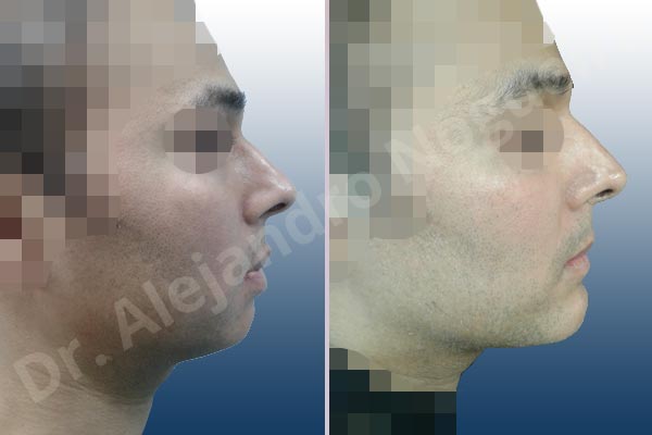 Small chin,Weak chin,Large lips,Lower lip vermilion wedge resection,Elbow bone graft harvesting,Horizontal osseous chin grafting,Oblique chin osteotomy,Osseous chin advancement,Two dimensional genioplasty - photo 4