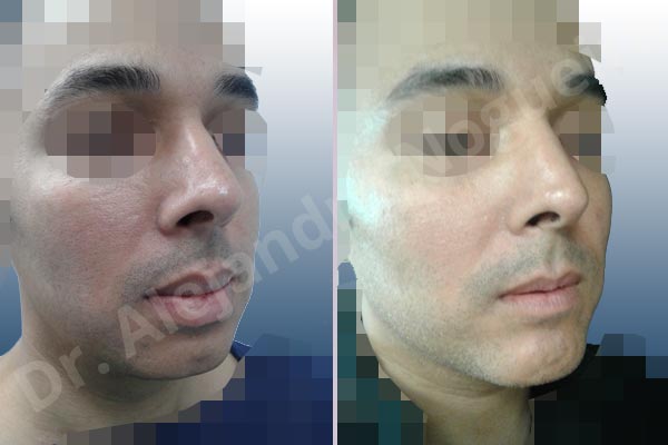 Small chin,Weak chin,Large lips,Lower lip vermilion wedge resection,Elbow bone graft harvesting,Horizontal osseous chin grafting,Oblique chin osteotomy,Osseous chin advancement,Two dimensional genioplasty - photo 5