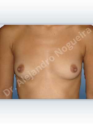 Asymmetric breasts,Cross eyed breasts,Narrow breasts,Skinny breasts,Small breasts,Anatomical shape,Extra large size,Lower hemi periareolar incision,Subfascial pocket plane