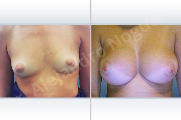 Asymmetric breasts,Cleft nipples,Empty breasts,Inverted nipples,Narrow breasts,Small breasts,Sunken chest,Anatomical shape,Extra large size,Subfascial pocket plane,Inframammary incision - photo 1