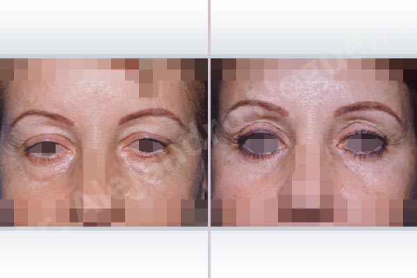 Baggy lower eyelids,Baggy upper eyelids,Saggy upper eyelids,Upper eyelids ptosis,Lower eyelid fat bags resection,Transconjunctival approach incision,Upper eyelid fat bags resection,Upper eyelid skin and muscle resection - photo 1