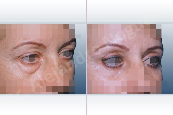 Baggy lower eyelids,Baggy upper eyelids,Saggy upper eyelids,Upper eyelids ptosis,Lower eyelid fat bags resection,Transconjunctival approach incision,Upper eyelid fat bags resection,Upper eyelid skin and muscle resection - photo 2
