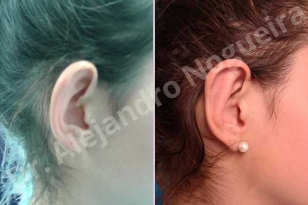 Large ears,Prominent ears,Concha crescent resection,Mustardé antihelical suturing - photo 4