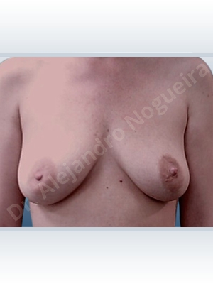 Asymmetric breasts,Cross eyed breasts,Empty breasts,Lateral breasts,Mildly saggy droopy breasts,Moderately saggy droopy breasts,Pigeon chest,Small breasts,Anatomical shape,Anchor incision,Extra large size,Subfascial pocket plane,Superior pedicle