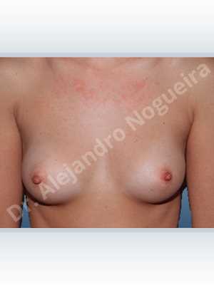 Cross eyed breasts,Narrow breasts,Skinny breasts,Small breasts,Anatomical shape,Lower hemi periareolar incision,Subfascial pocket plane