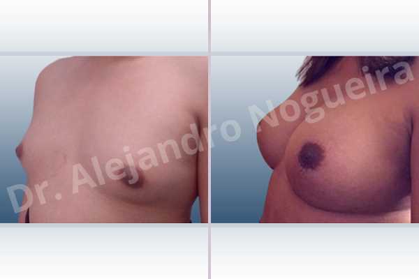 Asymmetric breasts,Cross eyed breasts,Empty breasts,Lateral breasts,Small breasts,Too far apart wide cleavage breasts,Transgender breasts,Wide breasts,Anatomical shape,Extra large size,Inframammary incision,Subfascial pocket plane - photo 3