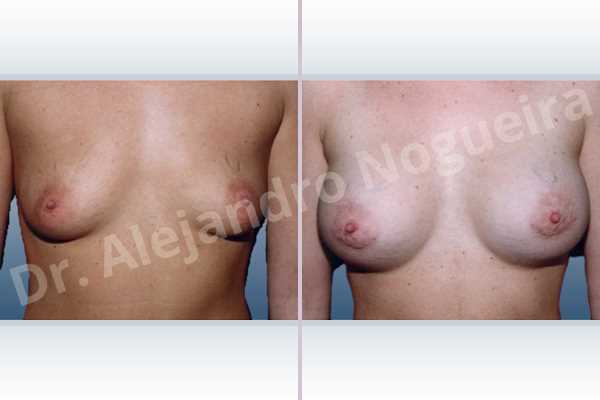 Empty breasts,Lateral breasts,Skinny breasts,Slightly saggy droopy breasts,Small breasts,Sunken chest,Too far apart wide cleavage breasts,Anatomical shape,Lower hemi periareolar incision,Subfascial pocket plane - photo 1