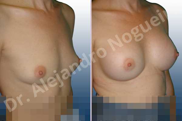 Lateral breasts,Skinny breasts,Small breasts,Too far apart wide cleavage breasts,Anatomical shape,Lower hemi periareolar incision,Subfascial pocket plane - photo 5