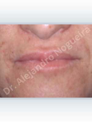 Small lips,Upper lip autologous dermis collagen filler