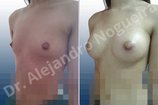 Asymmetric breasts,Empty breasts,Narrow breasts,Skinny breasts,Small breasts,Sunken chest,Anatomical shape,Lower hemi periareolar incision,Subfascial pocket plane - photo 3