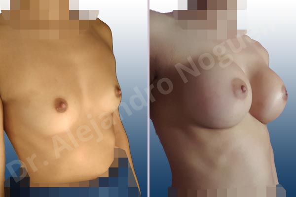 Asymmetric breasts,Empty breasts,Narrow breasts,Skinny breasts,Small breasts,Extra large size,Inframammary incision,Round shape,Subfascial pocket plane - photo 5