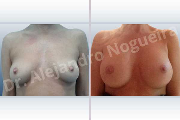 Asymmetric breasts,Empty breasts,Lateral breasts,Pigeon chest,Slightly saggy droopy breasts,Small breasts,Too far apart wide cleavage breasts,Wide breasts,Anatomical shape,Inframammary incision,Subfascial pocket plane - photo 1