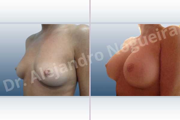 Asymmetric breasts,Empty breasts,Lateral breasts,Pigeon chest,Slightly saggy droopy breasts,Small breasts,Too far apart wide cleavage breasts,Wide breasts,Anatomical shape,Inframammary incision,Subfascial pocket plane - photo 3