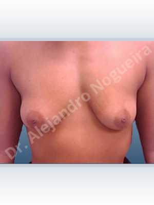 Asymmetric breasts,Cross eyed breasts,Empty breasts,Mildly saggy droopy breasts,Moderately saggy droopy breasts,Small breasts,Anatomical shape,Lower hemi periareolar incision,Subfascial pocket plane