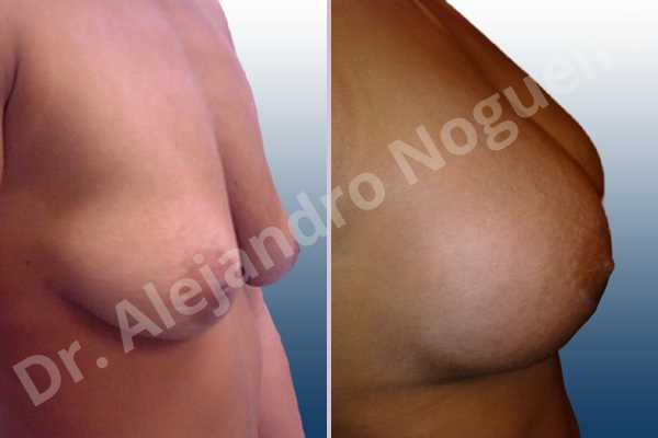 Asymmetric breasts,Cross eyed breasts,Empty breasts,Mildly saggy droopy breasts,Moderately saggy droopy breasts,Small breasts,Anatomical shape,Lower hemi periareolar incision,Subfascial pocket plane - photo 2