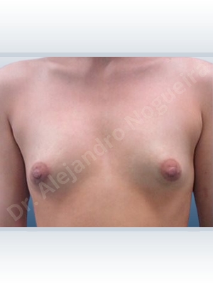 Asymmetric breasts,Lateral breasts,Skinny breasts,Slightly saggy droopy breasts,Small breasts,Sunken chest,Too far apart wide cleavage breasts,Tuberous breasts,Anatomical shape,Lower hemi periareolar incision,Subfascial pocket plane,Tuberous mammoplasty
