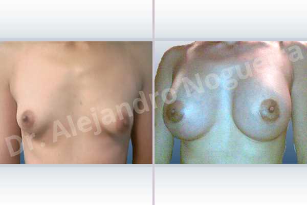 Asymmetric breasts,Cross eyed breasts,Empty breasts,Lateral breasts,Narrow breasts,Skinny breasts,Small breasts,Sunken chest,Too far apart wide cleavage breasts,Tuberous breasts,Anatomical shape,Lower hemi periareolar incision,Subfascial pocket plane,Tuberous mammoplasty - photo 1