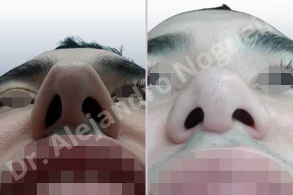 Before & After Case IAJKYWUC